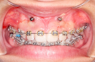 Frontal view of dental arches in biting teeth occlusion, orthodontic braces, elastic O-ring ligature and arch wire. Mini-implants in healthy gingival gum, lips retracted with cheek retractor. © MSC