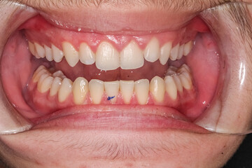 Frontal view of a unrecognisable young dentistry case man open mouth with a trace a on the lower...