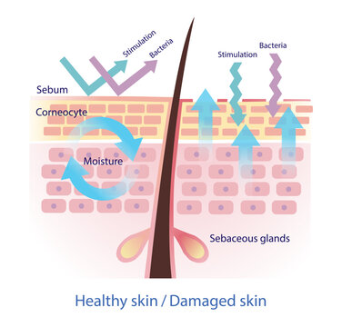 Comparison of healthy and damaged skin barrier vector on white background. The healthy sebum barrier protect skin from stimulation and bacteria. When sebum decreased, lead to more water leaving skin.