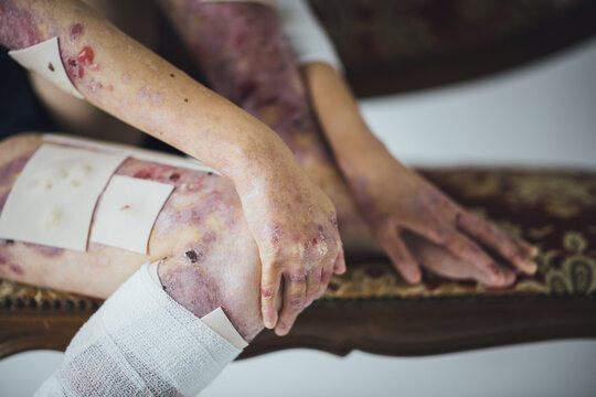 椅子に座りポージングをする表皮水疱症の女性