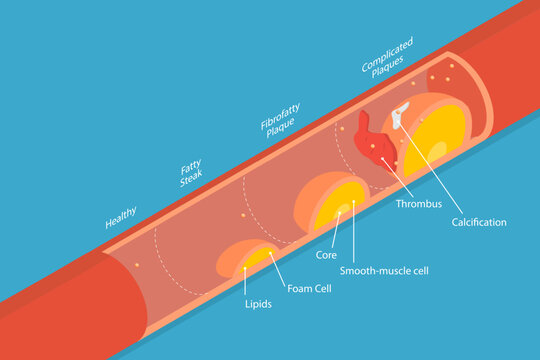 3D Isometric Flat Vector Conceptual Illustration of Stage Of Atherosclerosis, Cardiovascular Disease