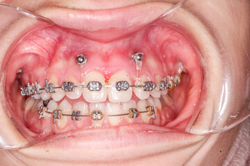 Frontal view of dental arches in biting teeth occlusion, orthodontic braces, elastic O-ring...