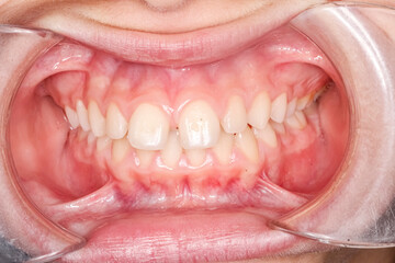 Frontal view of dental maxillary and mandibular arches in occlusion with biting teeth, diastema gap...