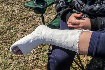 Plaster cast on human leg.A man with a plaster cast sits on a chair in nature