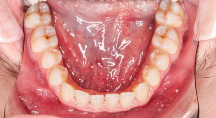 Dentistry case with unstraightened healthy teeth and no decay. Cheeks and lips retracted with cheek...