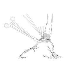 Gastroesophageal anastomosis surgery.This medical illustration shows the anastomosis technique of the remnant stomach and esophagus.Sketch.
