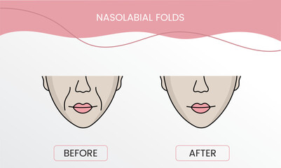 Nasolabial folds, laser cosmetology before procedure and after applying treatment in vector. Illustration of a woman with smooth clean skin and problematic skin.
