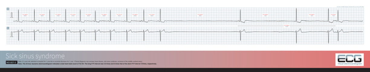 An 81 year old elderly male was clinically diagnosed with coronary heart disease and cerebral vascular insufficiency. The dynamic electrocardiogram indicated sick sinus syndrome.