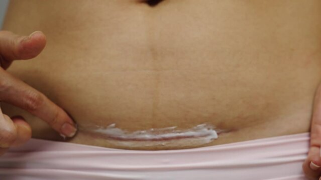 woman putting healing cream in the c-section scar of caesarean