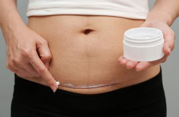 woman putting healing cream in c-section scar of cesarean