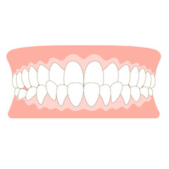上下反対の受け口の歯並び