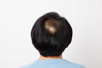 脱毛のある成熟した日本人の背景