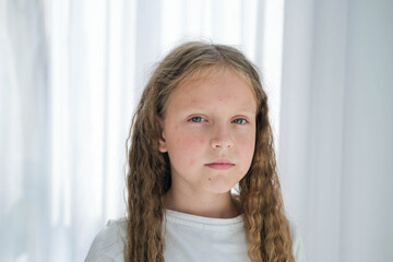 Portrait of a child with a rash from chickenpox. Girl with acne and cream on her face.