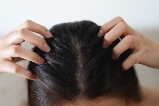 A Woman Has Problems With Hair And Scalp,she Has Dandruff From Allergic Reactions To Shampoos. And Hair Conditioner