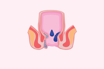 Cross section of the rectum and anal canal. hemorrhoids illustration. eps 10