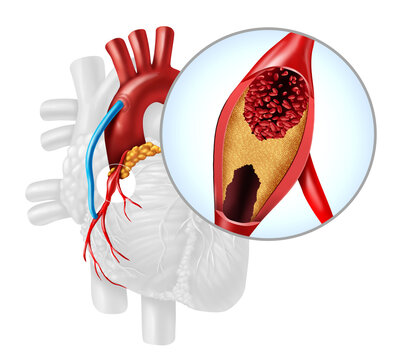 Heart Artery Bypass Grafting or CABG as an obstruction of plaque in the coronary artery or arteries as a vein from a leg that is grafted to a heart bypassing a blockage