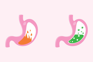 illustration of pyrosis stomach and nausea stomach. Pyrosis fire disorder, gastric acid reflux. Stomach medical illustration set. eps 10