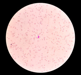 Photomicrograph of hematological slide showing Bicytopenia.