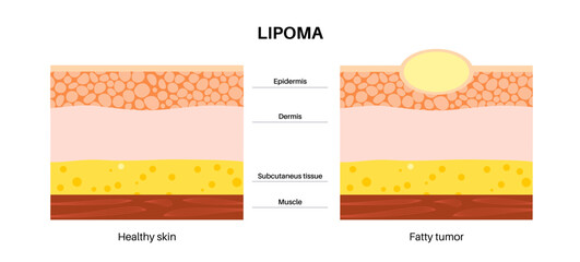 Lipoma medical poster