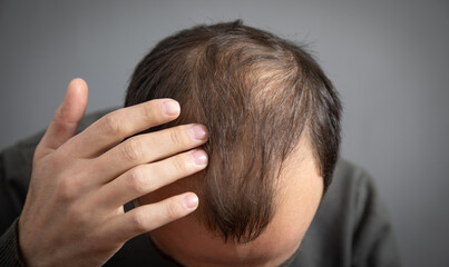 Fototapeta premium Caucasian man. Hair loss problem