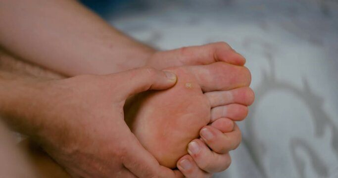 Wart verrucas plantar, self inspection man at home. Decease on foot skin. Close-up shot