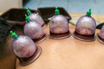 Traditional blood cupping therapy being performed on a patient's back