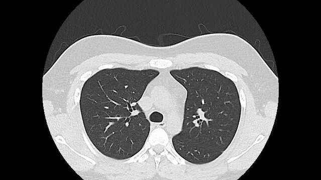 Ct x-ray scan of lung thorax fr a post-covid patient in black and white