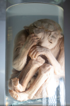 April 1, 2023. Belarus, Minsk. Exhibition of anatomical exhibits. A human infant with the pathological development of anencephaly - the absence of most of the brain, skull and scalp.