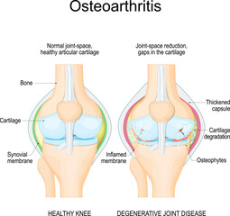 Osteoarthritis. arthritis. - obrazy, fototapety, plakaty