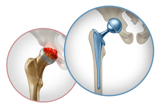 Hip Surgery and pelvic joint Replacement  concept as an artificial joint or prosthesis with orthopedic surgery inserting a metal ball and socket 