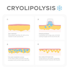 Vector infographic of the cryolipolysis process.
Layers of skin and tissues, before and after fat freezing treatment.
Graphic design illustration of fat freezing and reduction of fat cells
