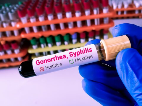 Doctor holding a blood sample for Syphilis and Gonorrhea test. VDRL, TPHA.