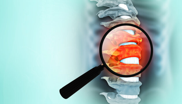 Lumbar intervertebral spine hernia. 3d illustration