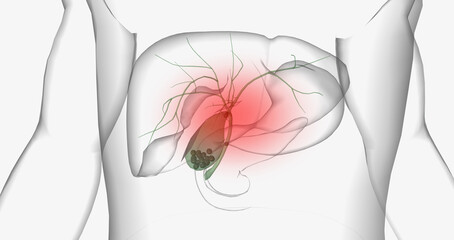 Gallstones are pieces of solid material that form in the gallbladder, a small hollow organ located beneath the liver.