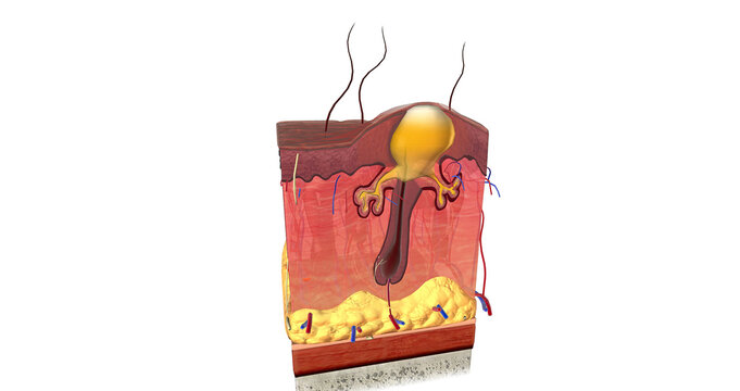 Acne is caused by a combination of factors acting on sebaceous glands and hair follicles in the skin.