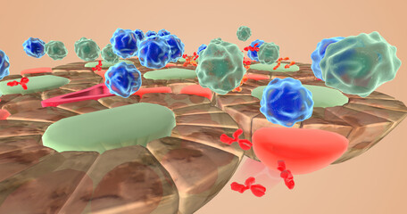 Autoimmune attack on thyroid cells