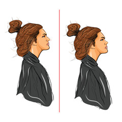vectorial nose surgery, before and after
