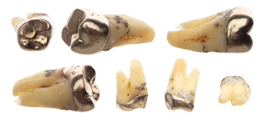 Pulled Molar Tooth with gold crown to show many angle, advanced caries rotten tweezer on root bone...