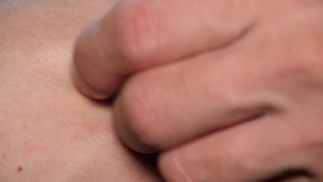 Slow motion speed closeup scene of hand scratching on arm, rash from plant allergic, itchy from mosquito attack in nature environment, bump on skin after bug bite, weather change itch