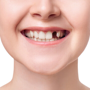 Woman teeth with hole. Dental implant concept.