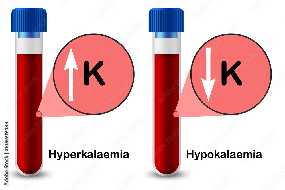 Poster hyperkalaemia and hypokalaemia with test sample in test tube