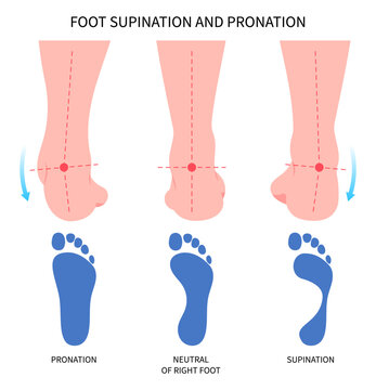 Pronation supination inward roll Feet over and Achilles Lower high fallen laxity Obesity hollow excessive of Patellofemoral tendon ligament medial tibial stress syndrome knee toe athletes sport