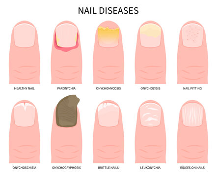 nail pain or onycholysis yellow peeling toes health and Beau's line syndrome white bands ridge damage of split care Tinea liver zinc iron crumbly fissure bed matrix spots big spoon kidney cancer
