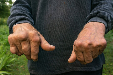 Rheumatoid arthritis of the hands of an elderly old man on a green background.