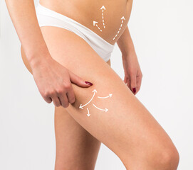 Cellulite removal scheme on legs. White arrows markings on legs young girl. Plastic and cosmetic surgery. - 607122487