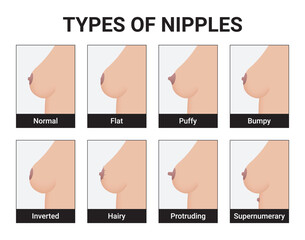 Types of Nipples Medical Vector Illustration