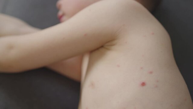 chickenpox rash blisters filled liquid on child skin back stomach and body. close-up view pox pimples varicella virus disease wise spread problem. vaccination prevention concept health care kid 