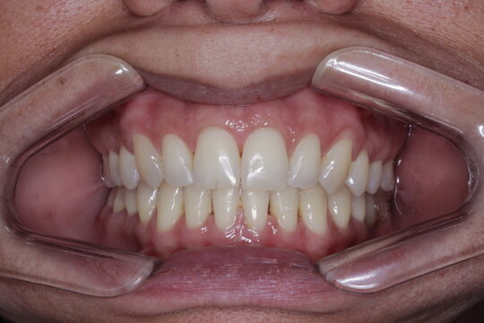 bocas de pacientes 