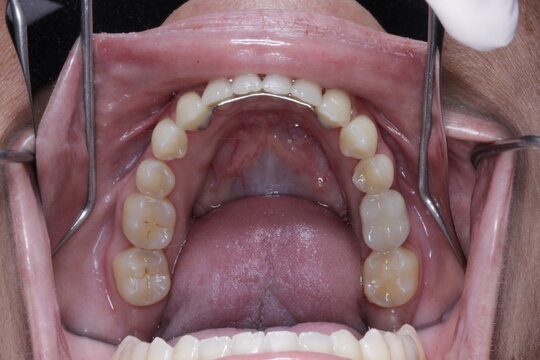 bocas de pacientes 