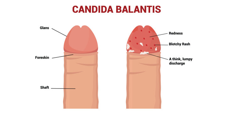 Candida Balanitis Vector Illustration.    Healthy penis and infected
